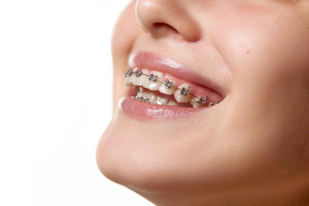 Close-up of metal braces treatment for straighter teeth and healthy smile
