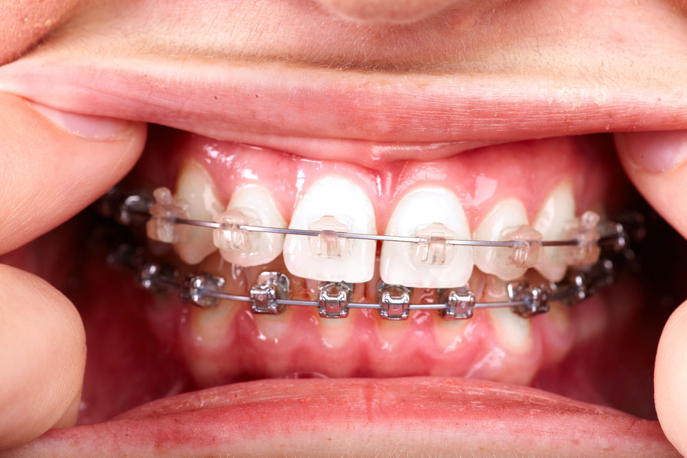 Close-up of metal braces correcting teeth alignment and bite issues
