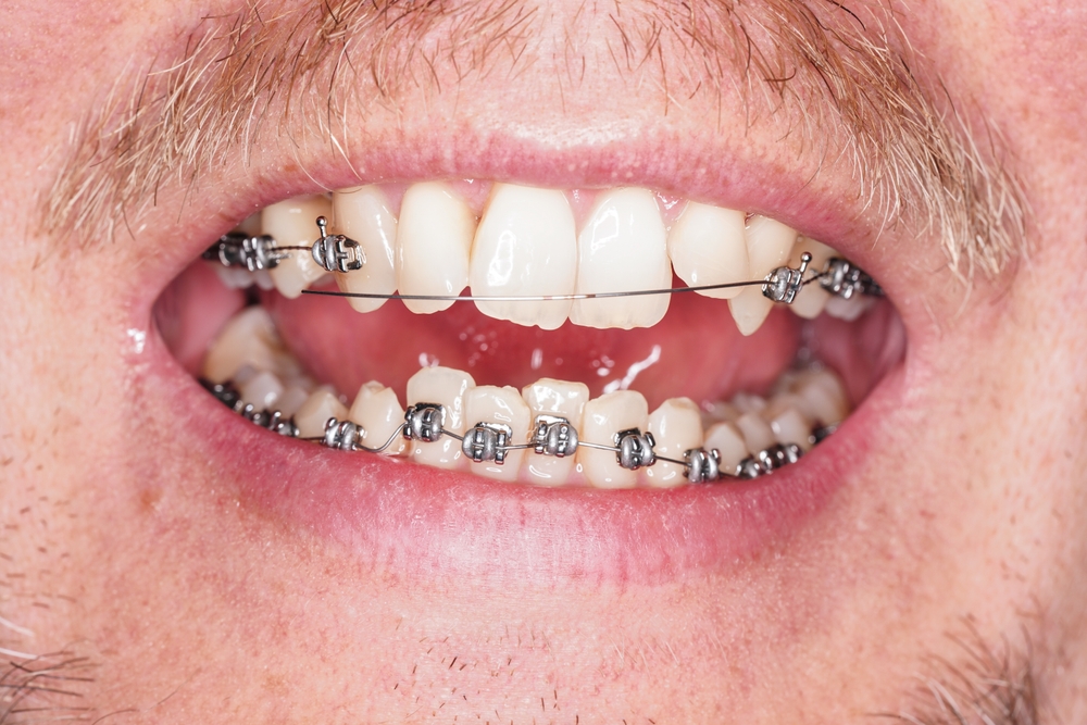 Emergency Orthodontist in Raleigh